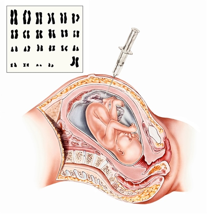 Pregnancy - Amniocentesis. A sample of amniotic fluid is tested to detect fetal age, sex, chromosome abnormalities, neural tube defects, inherited diseases, and fetal Rh factor sensitization. Image Credit: Medical Art Inc